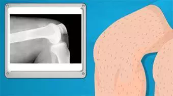 Betätigen Sie nun! Knee Surgery