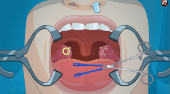 Betätigen Sie nun! Tonsil Chirurgie