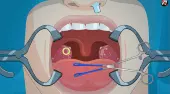 Betätigen Sie nun! Tonsil Chirurgie